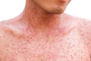 Por sarampi&oacute;n, Secretar&iacute;a de Salud emite alerta de viaje a 63 pa&iacute;ses